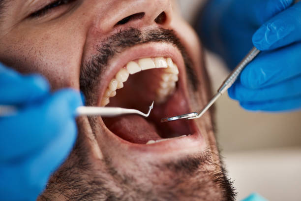 Best Emergency Dental Filling Replacement  in Parkston, SD